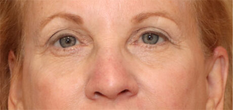 Eyelid Surgery case #2322