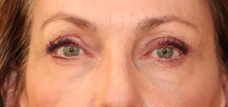 Eyelid Surgery case #2339