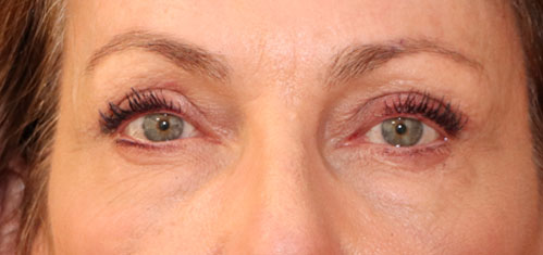 Eyelid Surgery case #2339