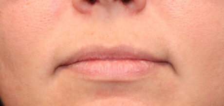 Dermal Fillers case #2350