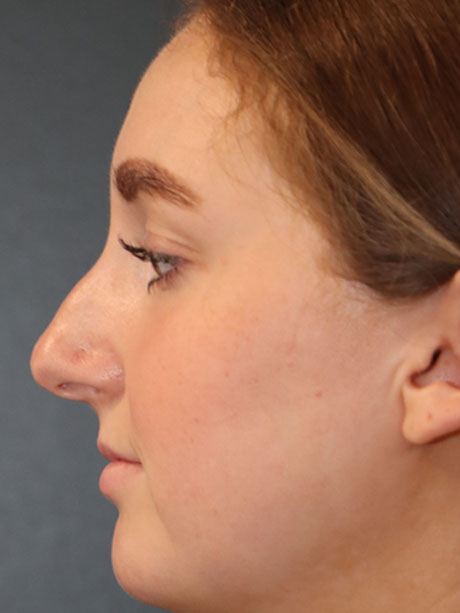 Rhinoplasty case #2257