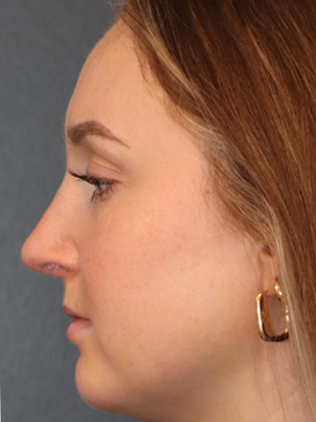 Rhinoplasty case #2257