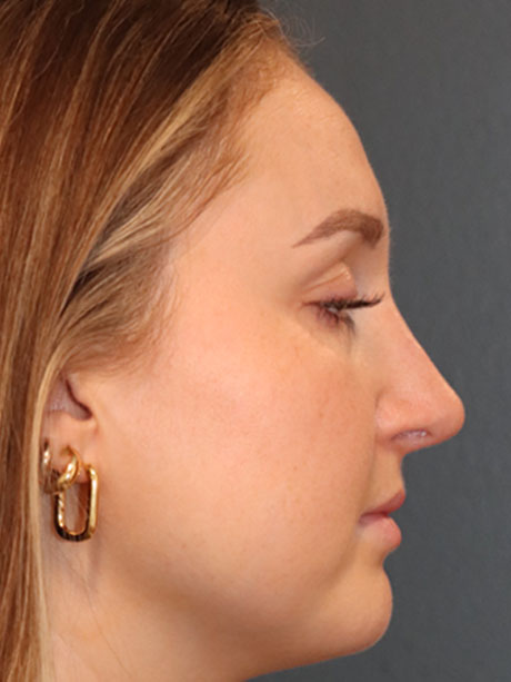 Rhinoplasty case #2257