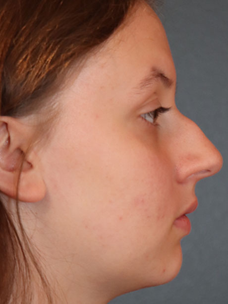 before and after plastic surgery results | Raj Dedhia MD San Francisco, CA rhinoplasty