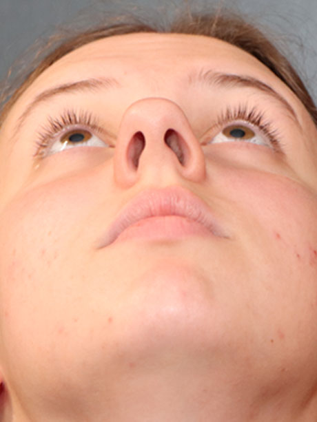 Rhinoplasty case #2270