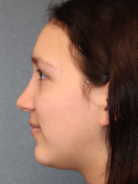 Rhinoplasty case #2283