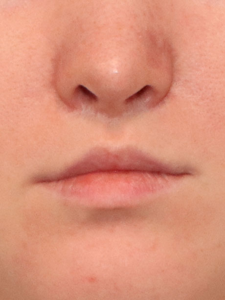 Lip Lift case #2296