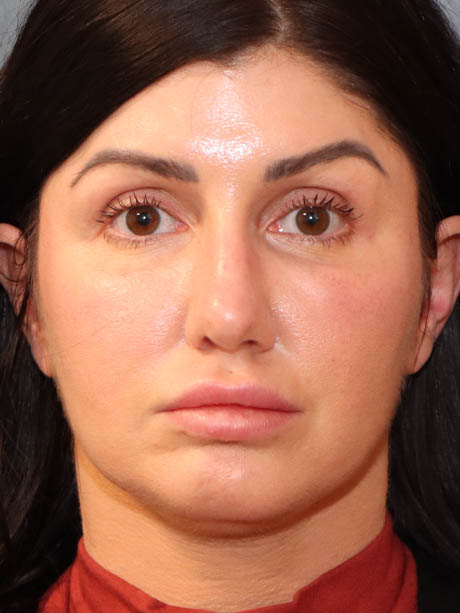Rhinoplasty case #5340