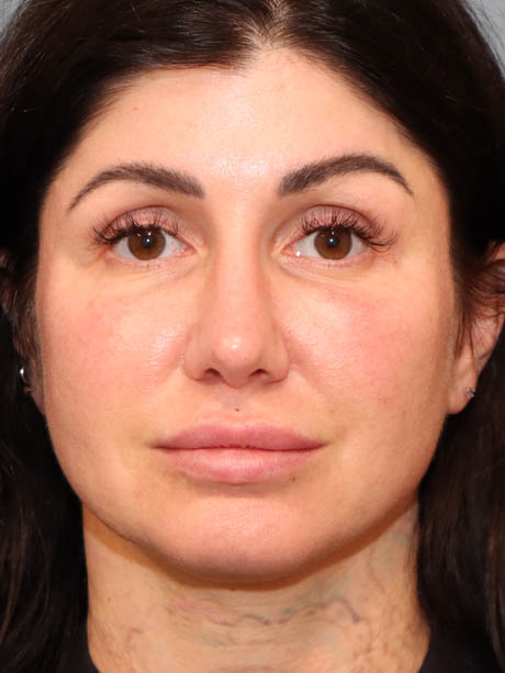 Rhinoplasty case #5340
