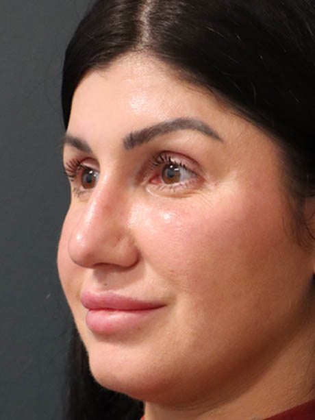 Rhinoplasty case #5340