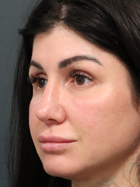 Rhinoplasty case #5340