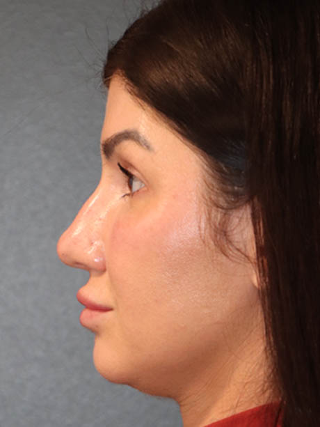 Rhinoplasty case #5340