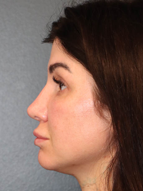 Rhinoplasty case #5340