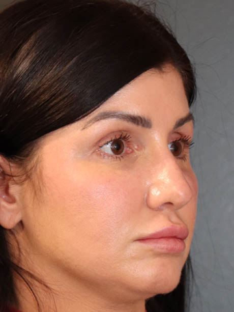 Rhinoplasty case #5340