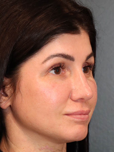 Rhinoplasty case #5340