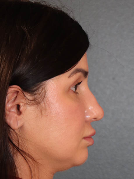 Rhinoplasty case #5340