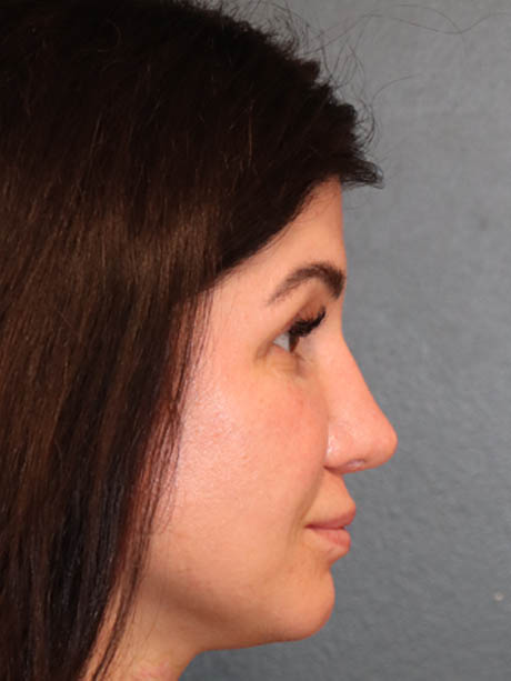 Rhinoplasty case #5340