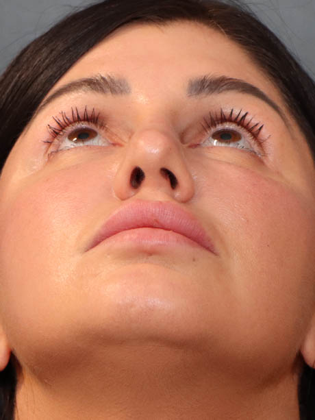 Rhinoplasty case #5340