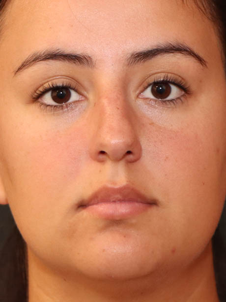Rhinoplasty case #5331