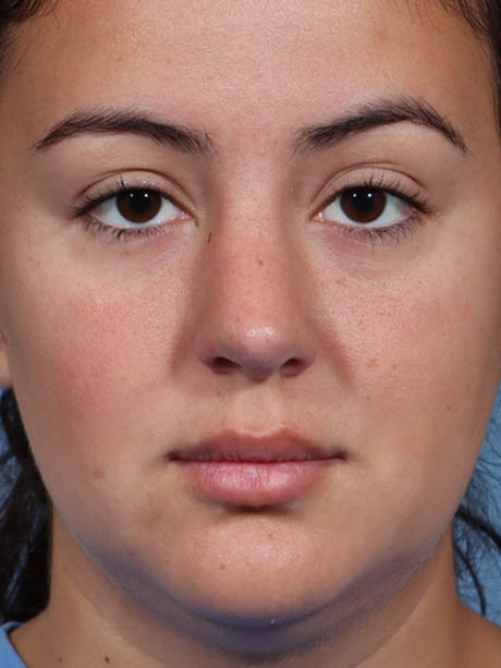 Rhinoplasty case #5331