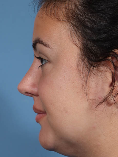 Rhinoplasty case #5331