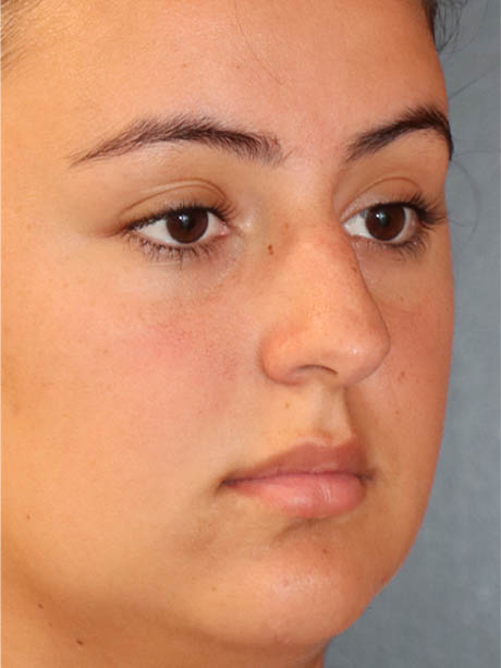 Rhinoplasty case #5331
