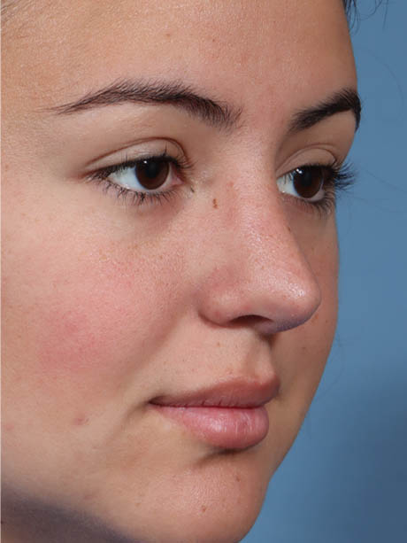 Rhinoplasty case #5331
