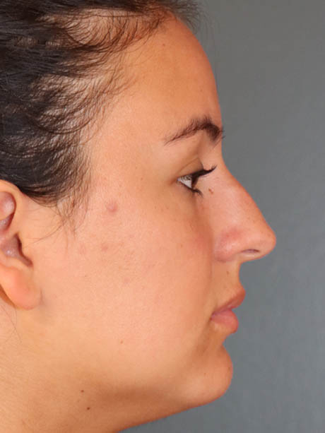 Rhinoplasty case #5331