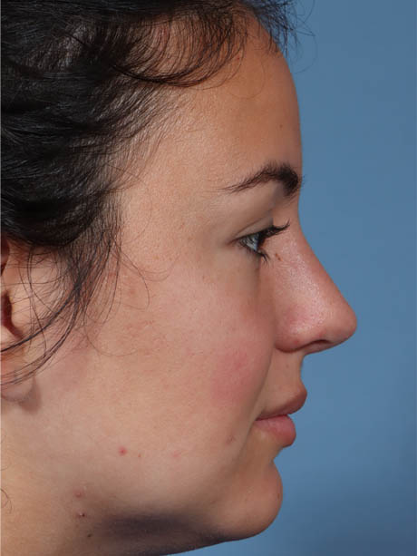 Rhinoplasty case #5331