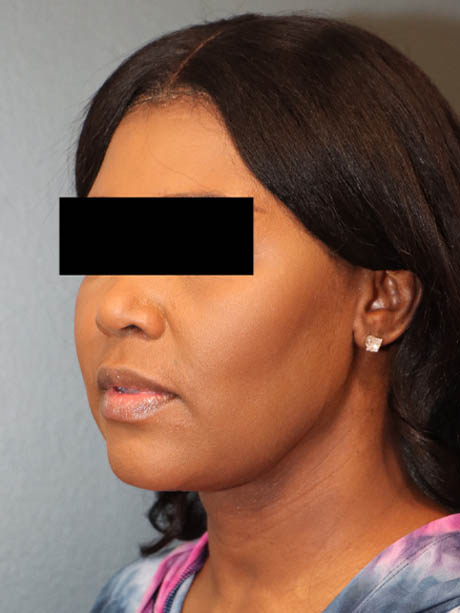 Neck Contouring case #5353