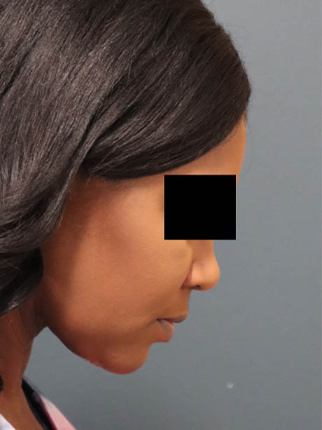 Neck Contouring case #5353