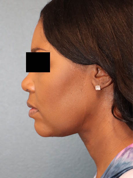 Neck Contouring case #5353