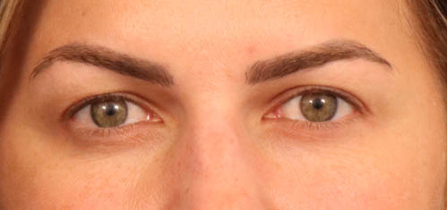 Eyelid Surgery case #5304