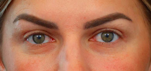 Eyelid Surgery case #5304