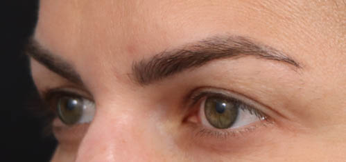 Eyelid Surgery case #5304