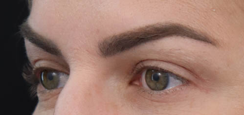 Eyelid Surgery case #5304