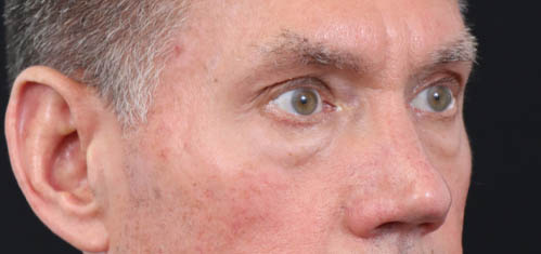 Eyelid Surgery case #5309