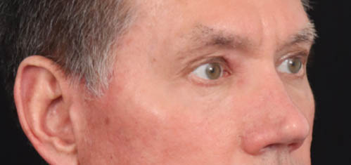 Eyelid Surgery case #5309