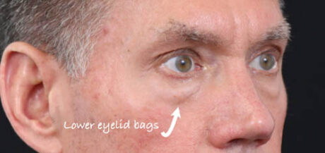 Eyelid Surgery case #5309