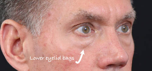 Eyelid Surgery case #5309