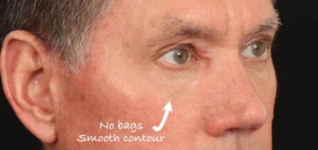 Eyelid Surgery case #5309